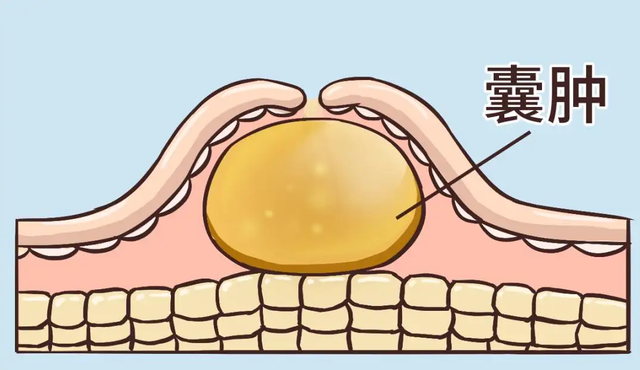 左侧小脑半球结节状异常信号_小脑半球下缘小结节是什么意思_小脑半球结节状稍高密度影