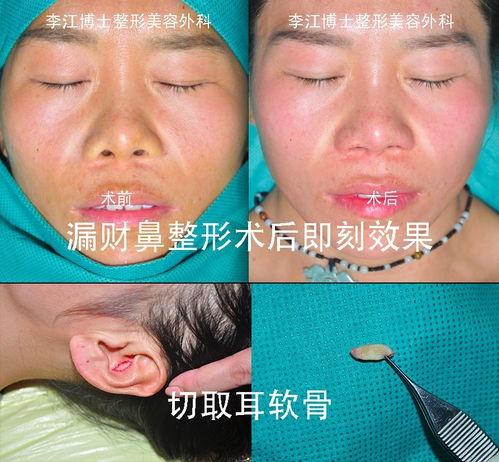 鼻孔整形手术,鼻孔整形手术——重塑鼻孔之美