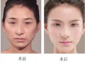 歪鼻整形手术,歪鼻整形手术——重塑鼻部轮廓，重拾自信笑容